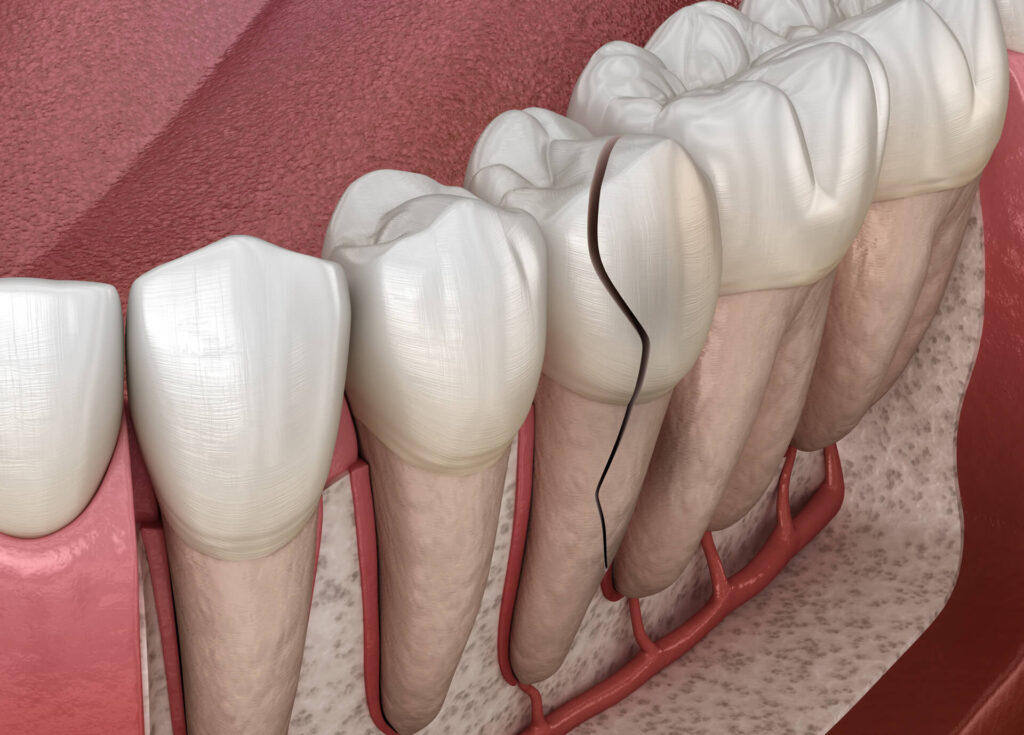 Cracked Tooth Repair: Dental Bonding - Cosmetic & General Dentist